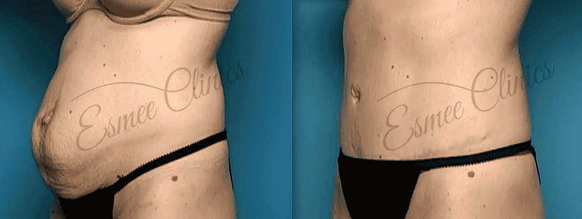 Before and After img